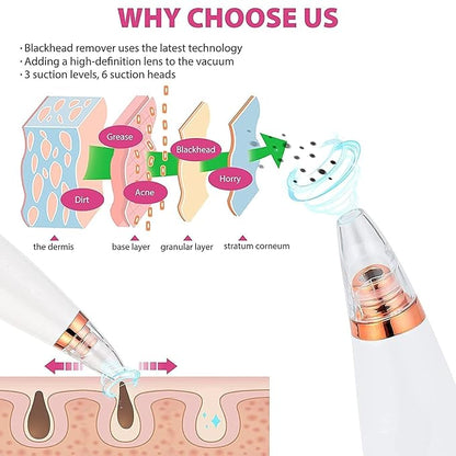 Blackhead Remover Vacuum Pore Cleaner 6 in 1 – Rechargeable Facial Acne & Whitehead Extraction Device